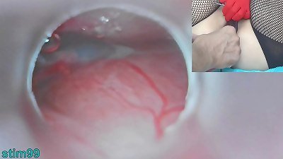 japanese Insemination with jizz into Uterus and Endoscope Camera by Cervix to witness inside womb Uncensored